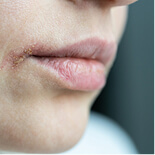 closeup-of-sore-woman-dry-lips-affected-by-herpes-2025-03-05-05-26-06-utc