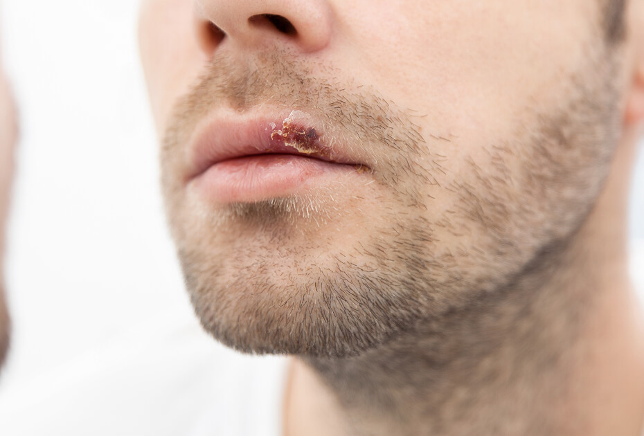 young-man-suffering-from-herpes-on-his-mouth-2024-09-16-17-54-29-utc (1)